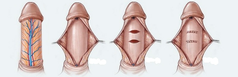 Plication for Peyronies disease treatment image