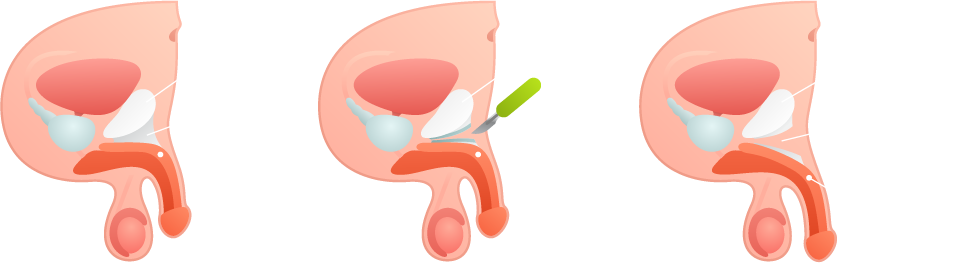 Penis Ligament Surgery 9