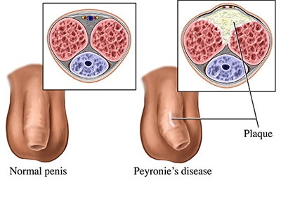 Diagram showing how plaque causes penis curvature