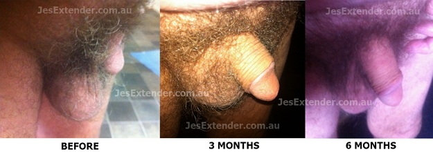 Before and after peyronies disease image