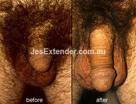 Jes Extender before and after picture (1) image