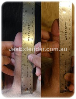 Jes Extender before and after picture (4) image