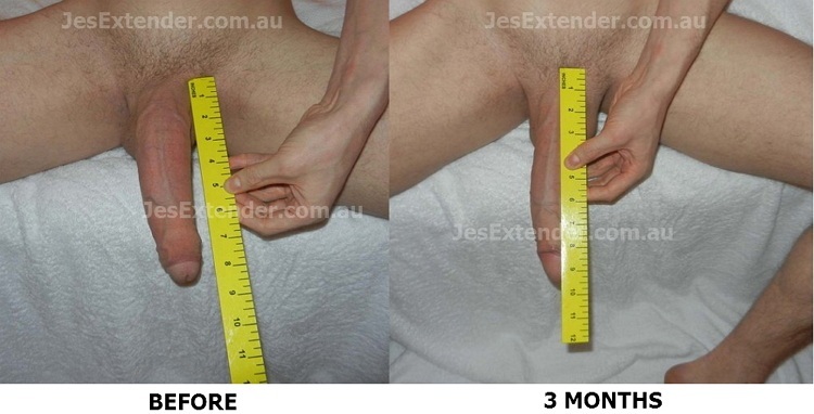 before and after penis size image